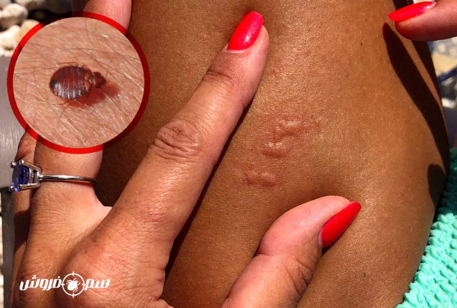 عکس نیش ساس در پوستهای تیرهتر