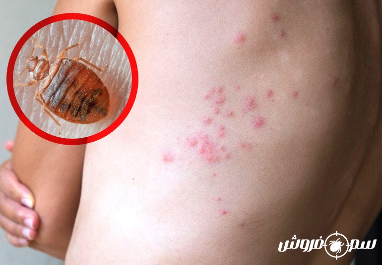 جای نیش ساس پشت بدن