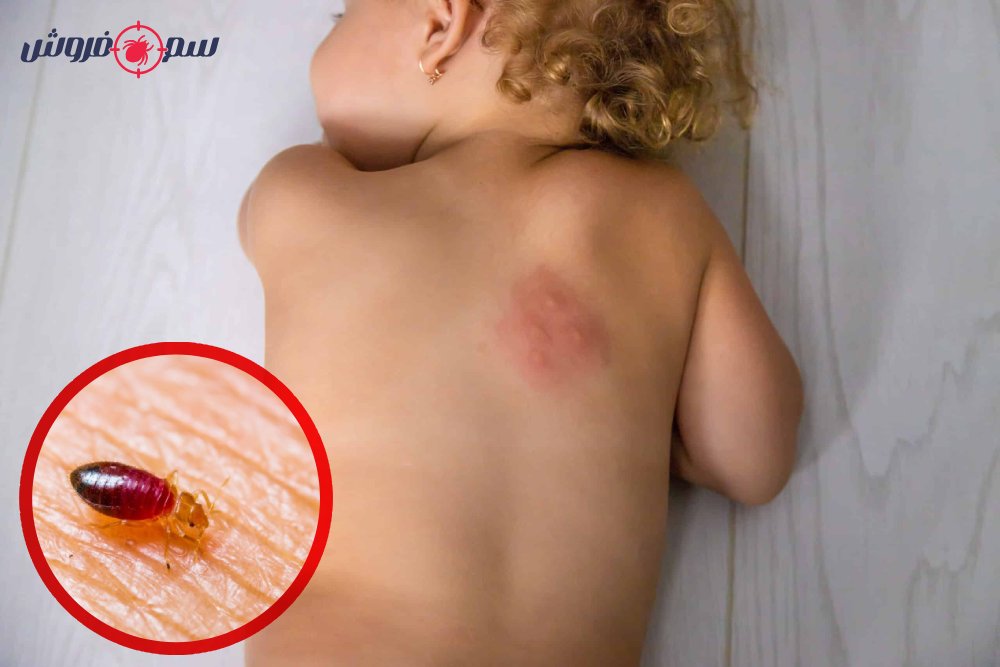 عکس نیش ساس در پشت بدن کودک