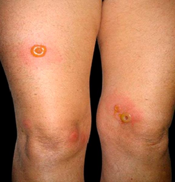 ضایعات تاولی غیرمعمول دراثر نیش ساس