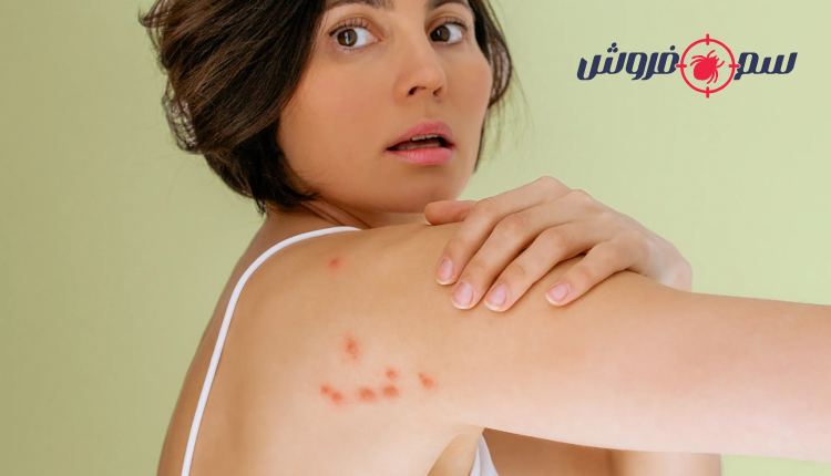 جای نیش ساس: تشخیص، عوارض و بهترین راههای درمان گزش ساس تختخواب