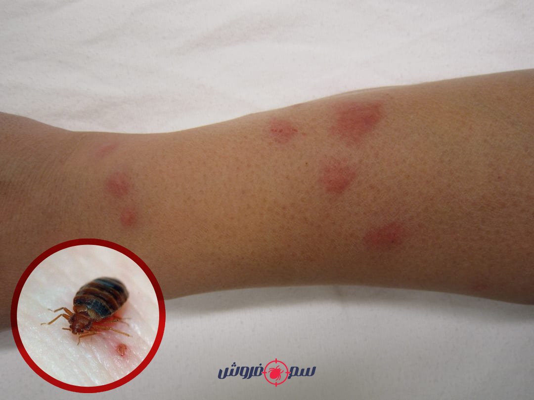 عکس نیش ساس در کودکان