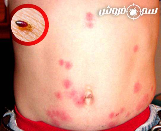 عکس نیش ساس روی شکم کودک