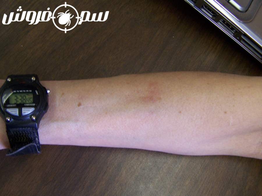 رد نیش ساس بعد از 17 روز