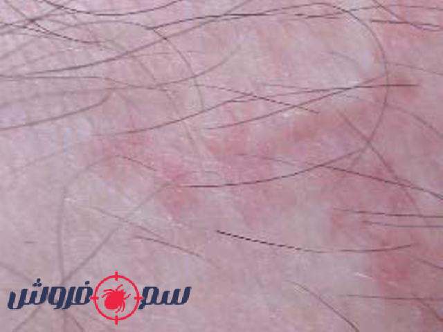 جاش نیش ساس 30 دقیقه پس از گزش