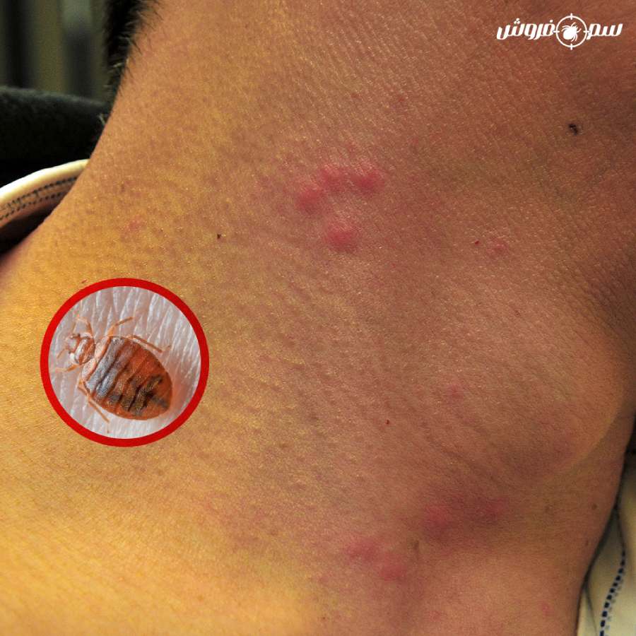 نیش ساس با الگوی دورانی روی گردن یک مرد