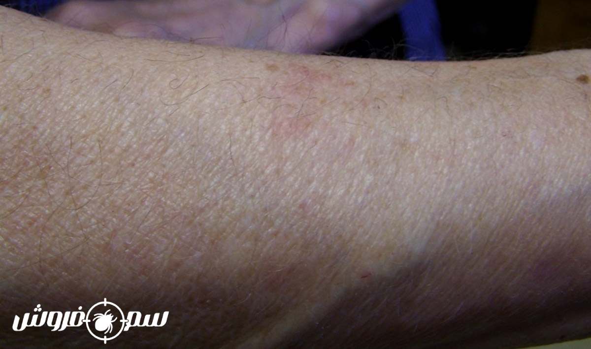 رد نیش ساس بعد از 4 روز