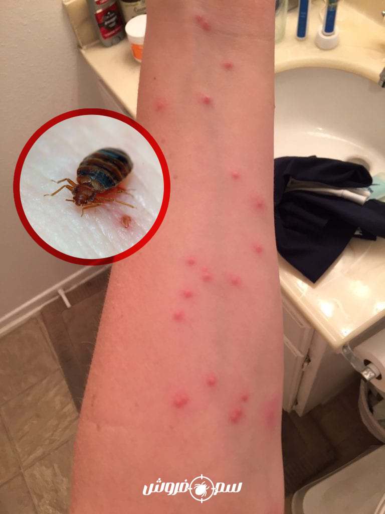 نیش ساس با الگوی خطی روی دست خانم