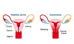 همه چیز در مورد سرطان دهانه رحم( سرویکس) علایم و درمان ها؟