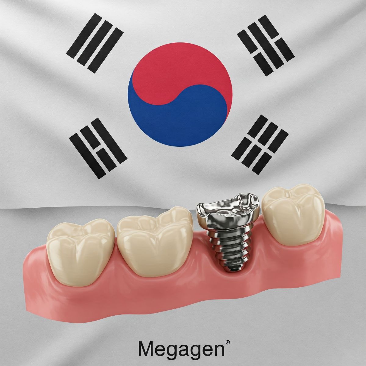 ایمپلنت مگاژن