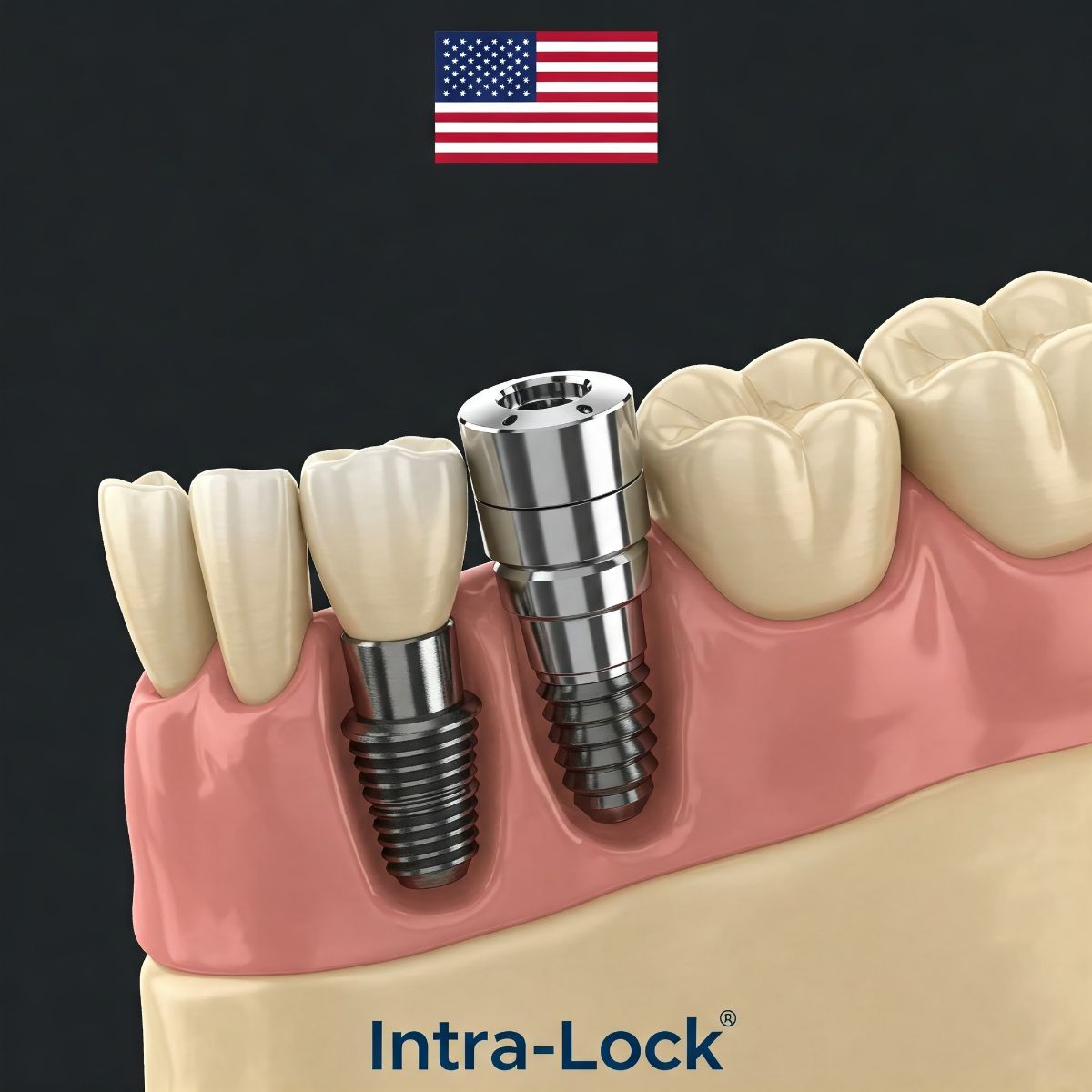 ایمپلنت اینترالاک