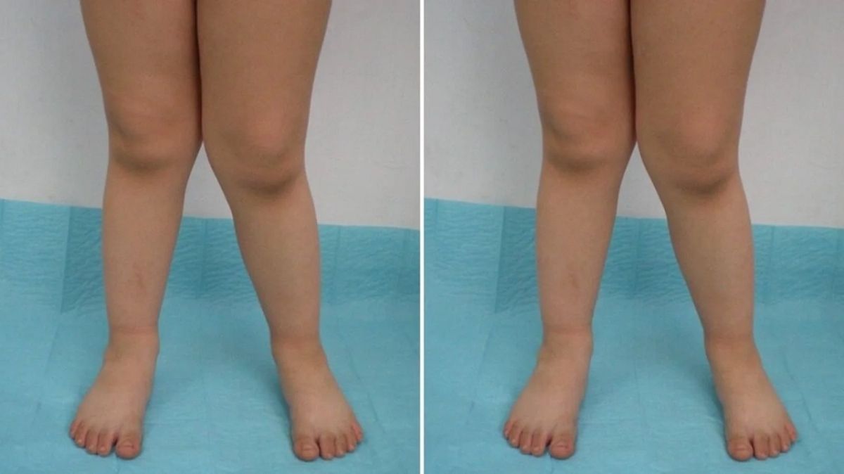 درمان زانوی ضربدری