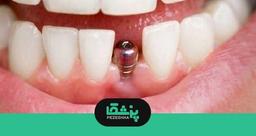 10 تا از بهترین متخصص ایمپلنت👨‍⚕️【سال1404】⚡