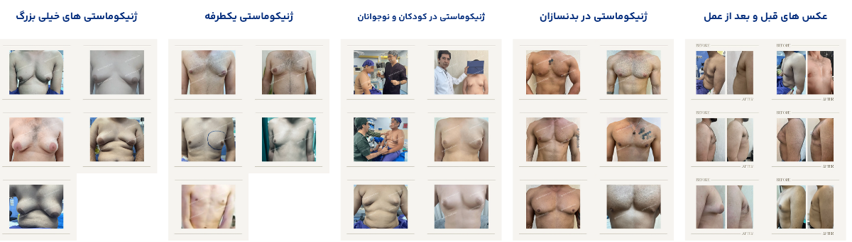 انواع اختلالات ژنیکوماستی را در [گالری تصاویر ژنیکوماستی] از سایت ما ملاحظه بفرمایید