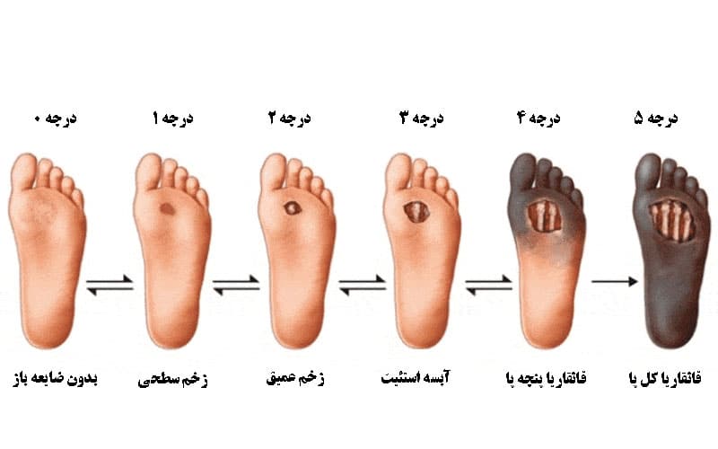 پیشگیری از زخم دیابتی