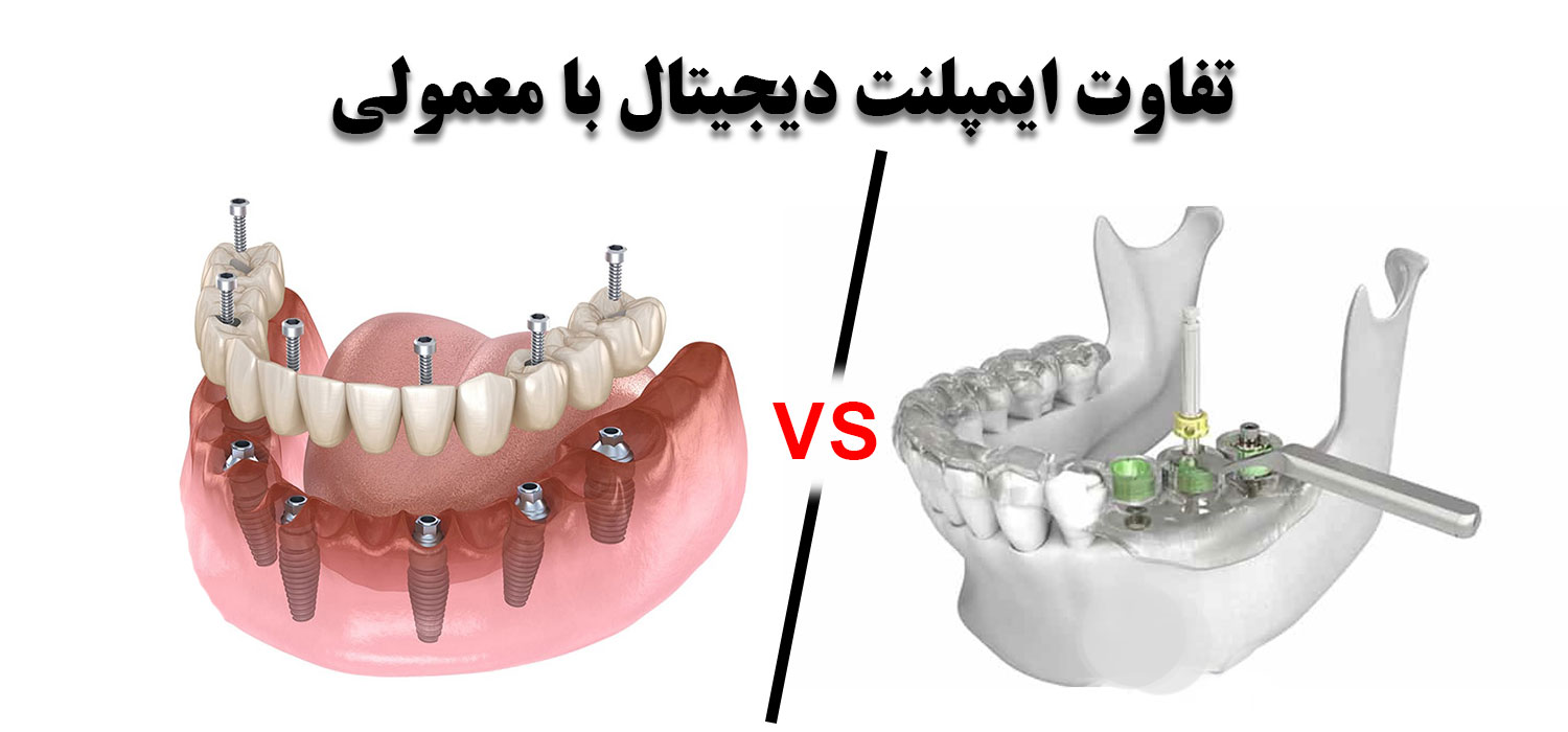 فرق ایمپلنت دیجیتال و معمولی