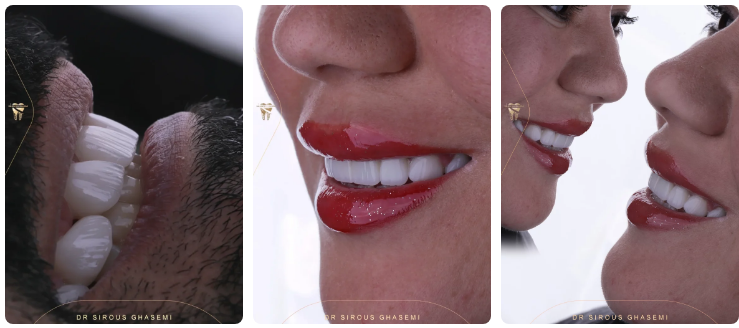 لبخندی طبیعی با جدیدترین روش‌های طراحی لبخند