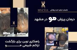 درمان ریزش مو در مشهد؛ راهکاری نوین برای بازگشت تراکم طبیعی مو
