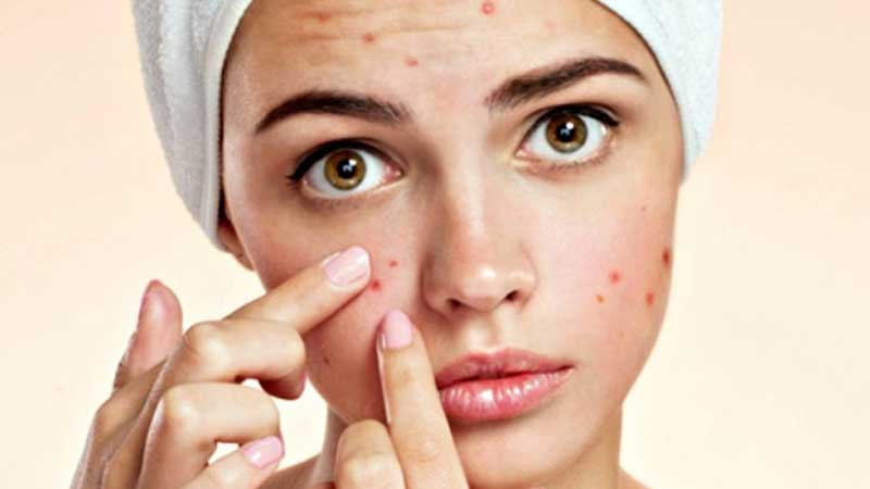 پوستت نفس می‌کشد: راز کاهش آکنه و درخشندگی پوست با حذف لبنیات