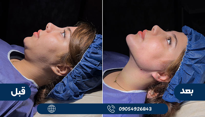 نمونه کار دکتر ملایی قبل و بعد ساکشن غبغب