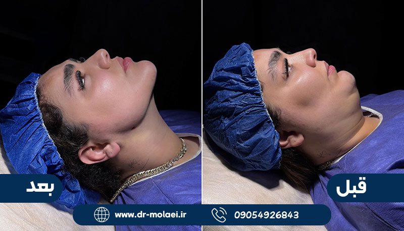 نمونه کار دکتر ملایی قبل و بعد ساکشن غبغب