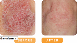 گانودرما و تاثیر آن بر پسوریازیس + نحوه مصرف