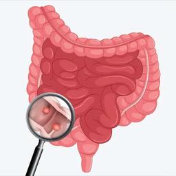 آمار نگران‌کننده پولیپ روده و راه نجات ساده
