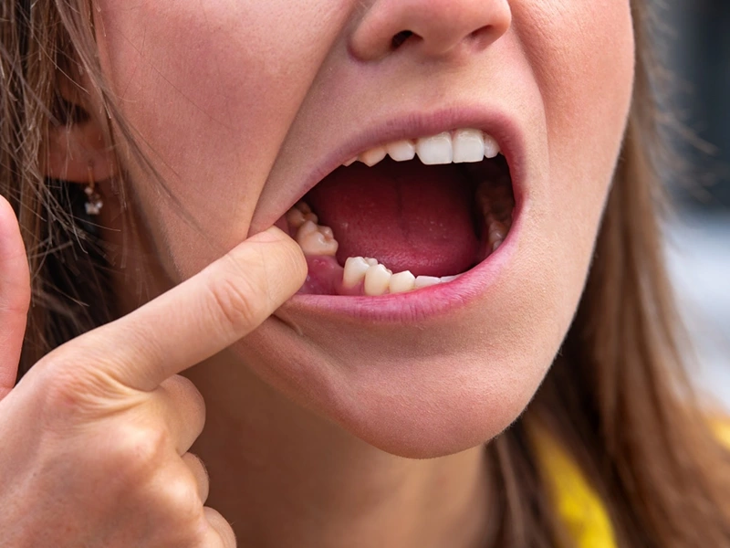 جای خالی دندان کشیده شده