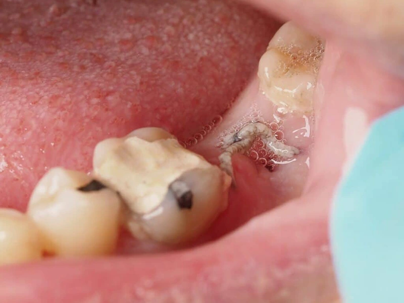 درمان عفونت جای دندان کشیده شده