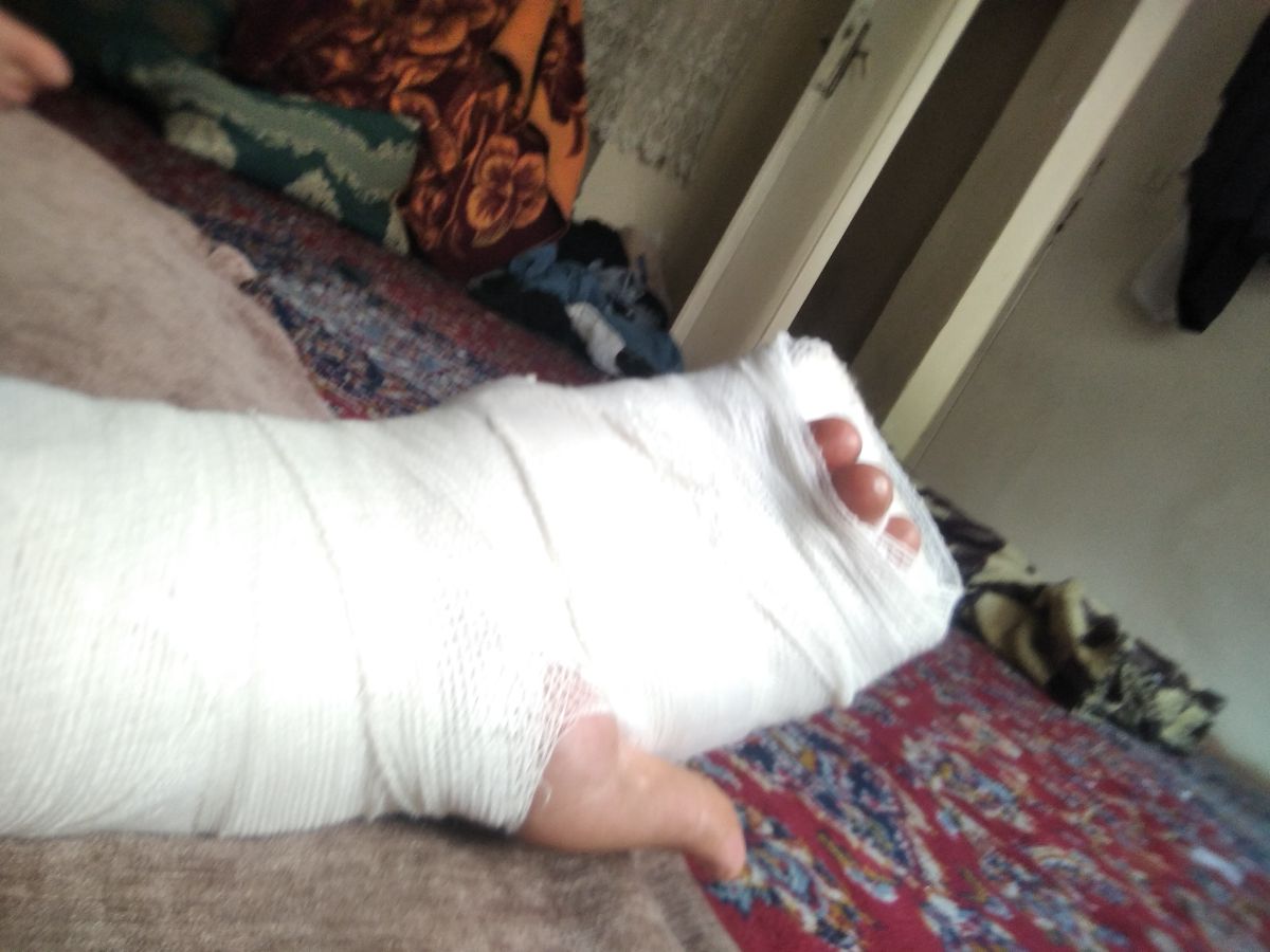 مچ شکسته|. تصادف با موتور.| تصادف کرمان| جاده د|ست شکسته |مچ شکسته |بازو شکسته |شکستگی|مچ شکسته|. تصادف با موتور.| تصادف کرمان| جاده د|ست شکسته |مچ شکسته |بازو شکسته |شکستگی|مچ شکسته|. تصادف با موتور.| تصادف کرمان| جاده د|ست شکسته |مچ شکسته |بازو شکسته |شکستگی|مچ شکسته|. تصادف با موتور.| تصادف کرمان| جاده د|ست شکسته |مچ شکسته |بازو شکسته |شکستگی|