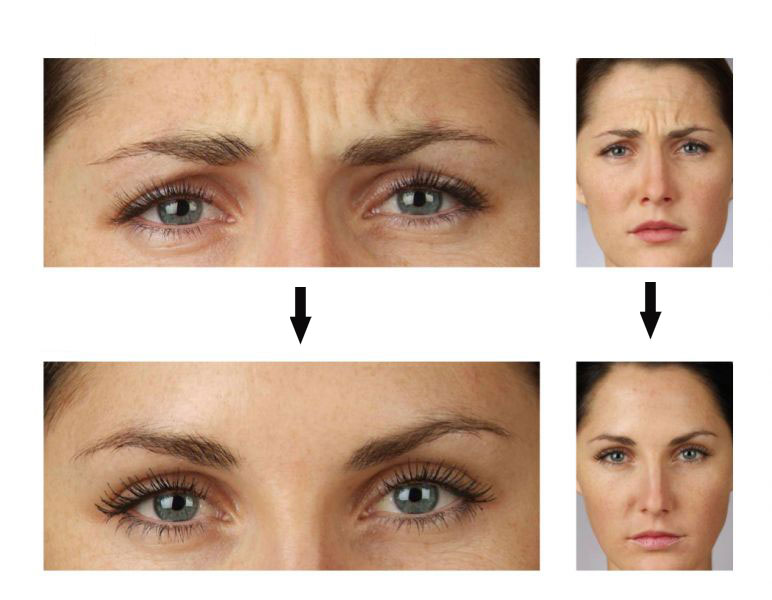 بوتاکس برای جوانسازی