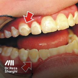 زرد شدن دندان‌ها بعد از اتمام ارتودنسی