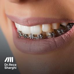 ارتودنسی یک فک: آیا می‌توان فقط دندان‌های یک فک را ارتودنسی کرد؟