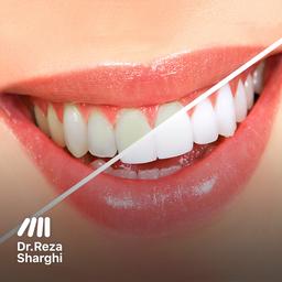 سفید کردن دندان‌ها (بلیچینگ)