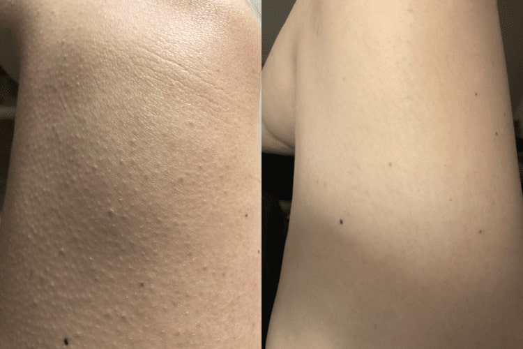 آمونیوم لاکتات برای پوست مرغی