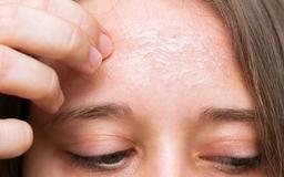 پوست خشک و راهکارهای گیاهی