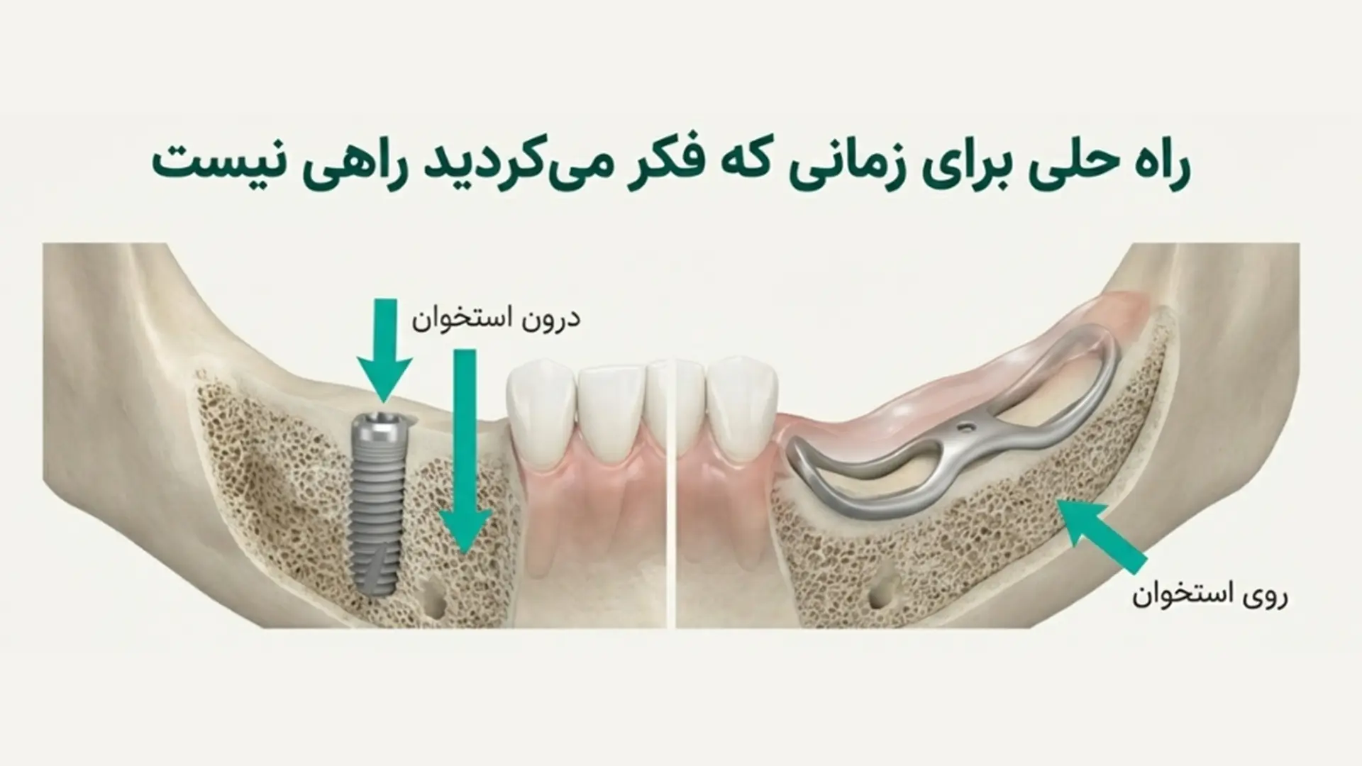 تفاوت ایمپلنت ساب پریوستئال با معمولی