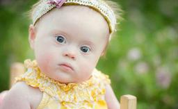 غربالگری سندروم داون چیست؟