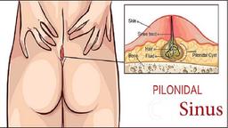 هزینه عمل کیست مویی در کلینیک نوین