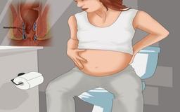بواسیر یا هموروئید شایع ترین عارضه بارداری