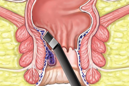 هموروئید شایع ترین بیماری زندگی ماشینی
