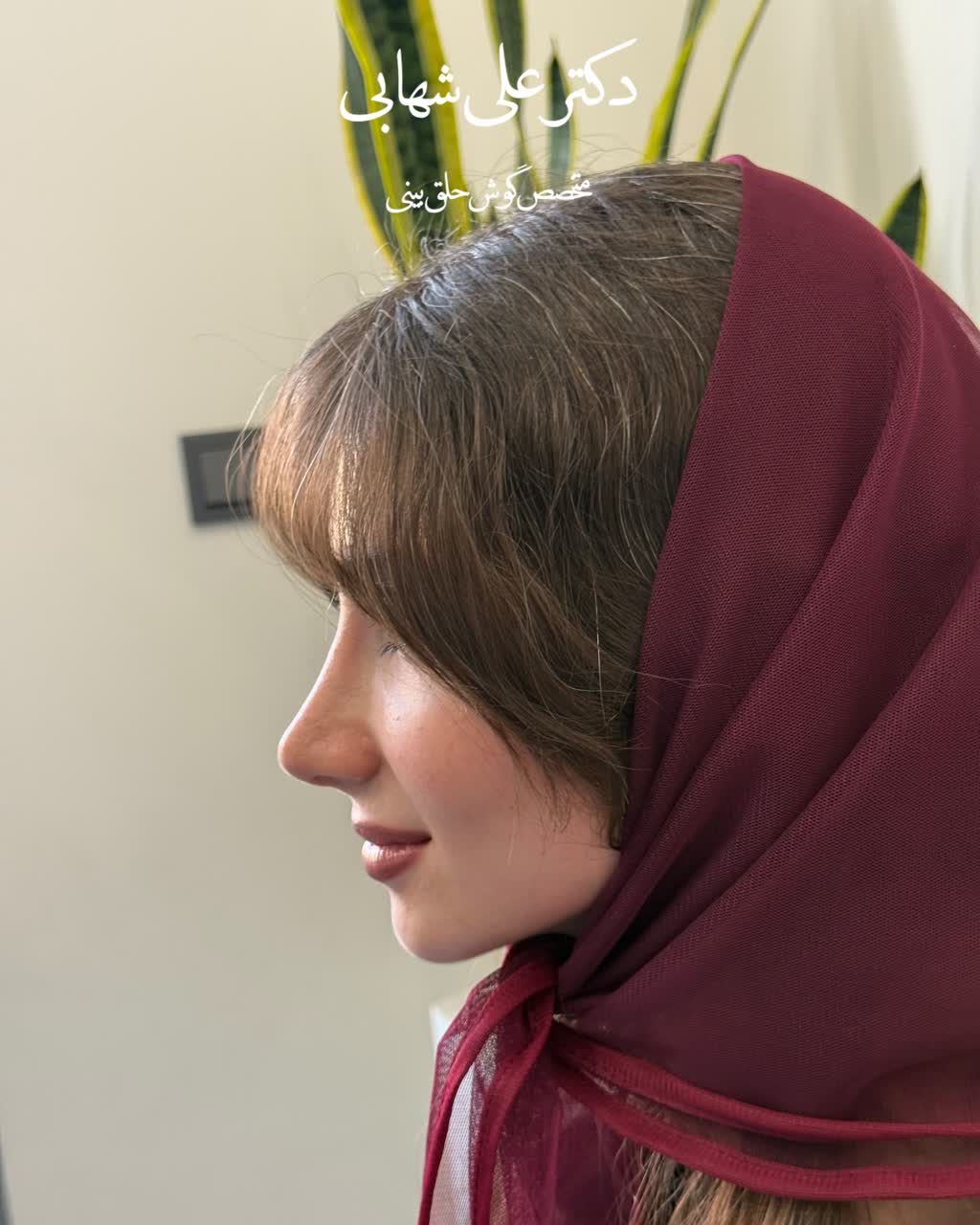 مراجعه بعد از عمل و نتیجه کار جراحی زیبایی بینی توسط دکتر علی شهابی