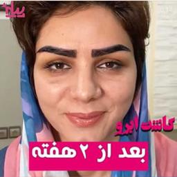 کاشت ابرو و روش های کاشت ابرو