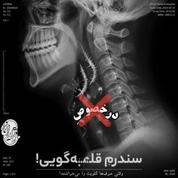 سندرم قلمبه گویی!(درمان اول)