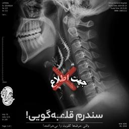 سندرم قلمبه گویی :  جهت زدگی!