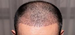 بهترین شهر برای کاشت مو کجاست؟