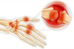 بیماری لوپوس چیست و چه علائم و درمانی دارد؟