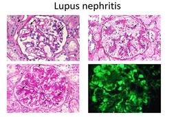 بیماری لوپوس چیست و چه علائم و درمانی دارد؟
