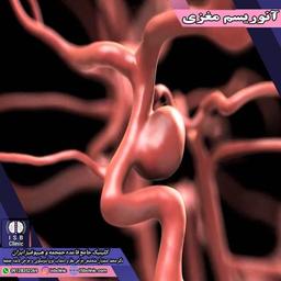 آنوریسم مغزی چیست؟ علایم آنوریسم مغزی و درمان آن