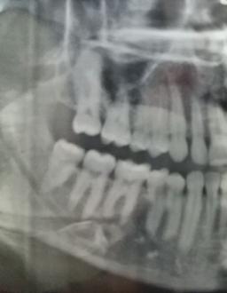 دندان عقل(چیزی که گوگل نگفت)